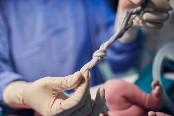  True Knots Explained and How They Can Impact Fetal Health