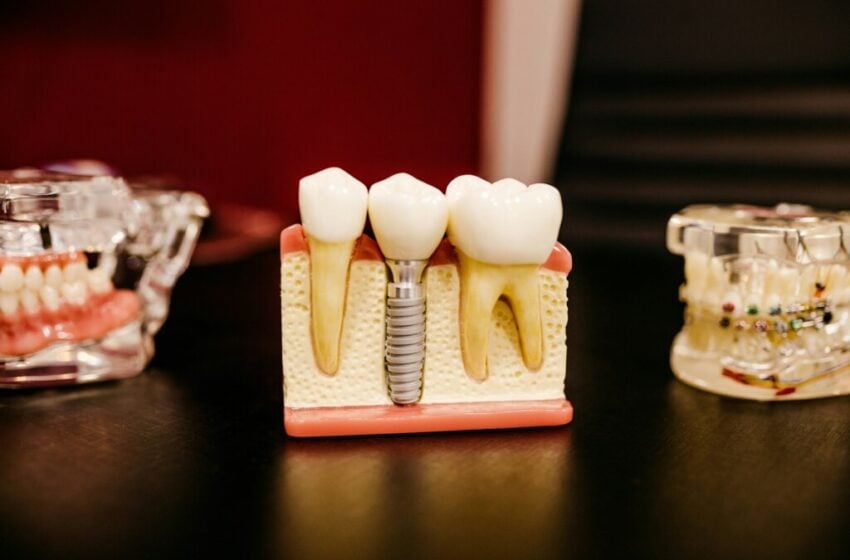  Revolutionizing Smiles: The Ultimate Guide to Dental Implants in Dubai